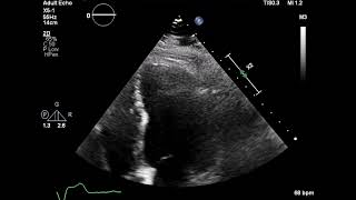 6 Apical Four Chamber LV