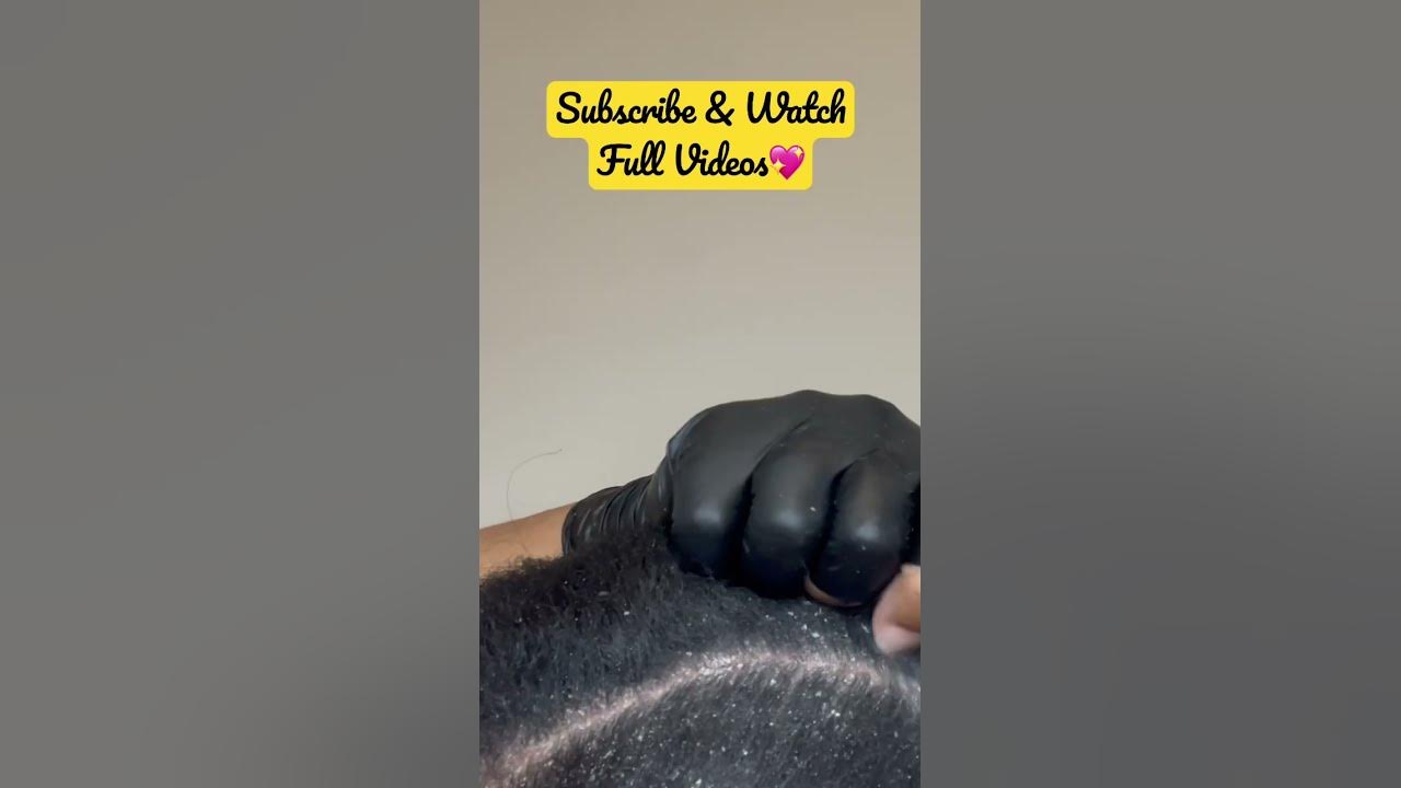 Scratching scabby itchy dry scalp scaly psoriasis flakes 