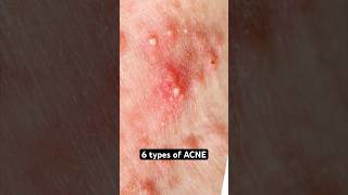 6 Types Of Acne Explained
