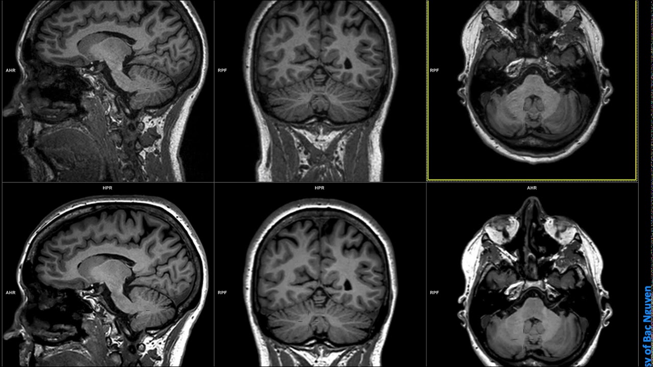 MR Neuro Imaging - MPRAGE @ Siemens 3T