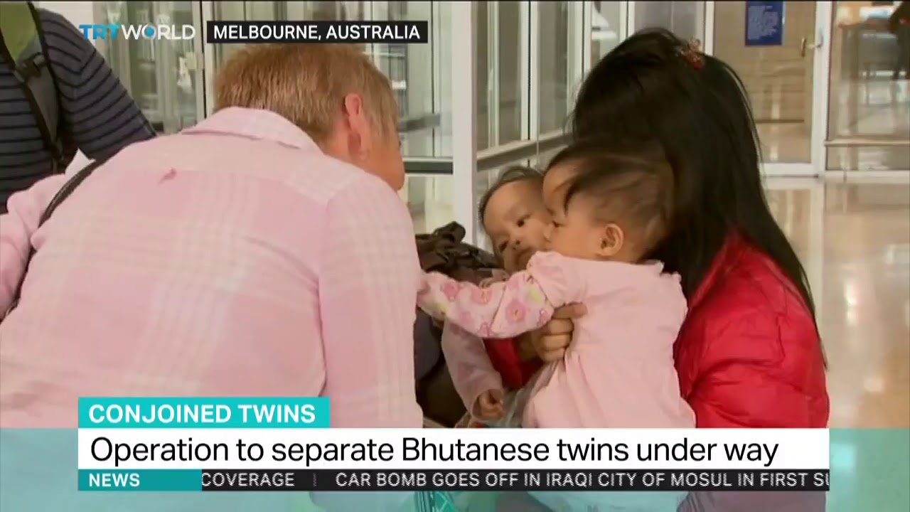Conjoined twins to be separated in Australia