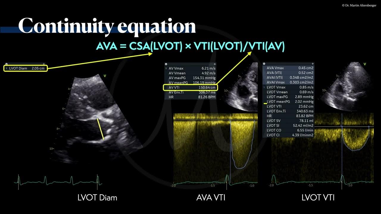  echocardiography the continuity equation in as a case example 