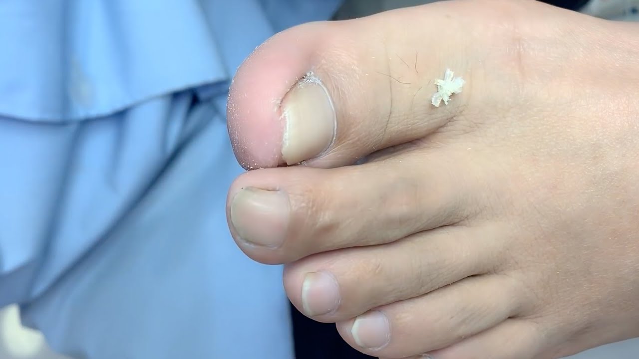 Simple Technique to Remove Dirt From Toenail Edge Easy Cleaning