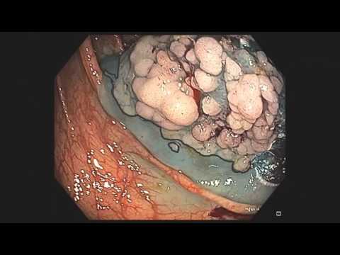 Piece Meal EMR eines Lateral Spreading Tumors LST