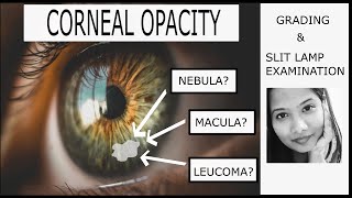 Corneal Opacity - Grading & Clinical Examination | Adherent Leucoma| Nebular, Macular & Leucomatous