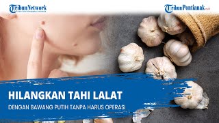 Hilangkan Tahi Lalat Dengan Bawang Putih Tanpa Harus Operasi
