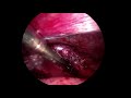 Appendicectomie Laparoscopique: Nos trois choix de ligature de la base
