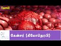      cancer chemotherapy  tamil