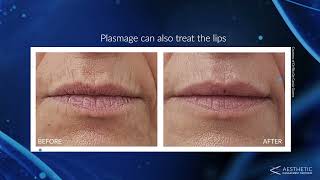 What Is Plasmage® - Introducing Fractional Plasma Technology To Treat Wrinkles & Other Skin Concerns