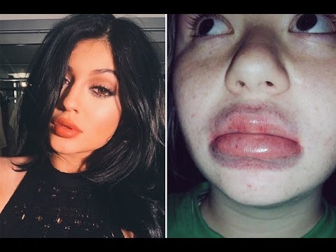 Kylie Jenner Lip Challenge Compilation Official Youtube
