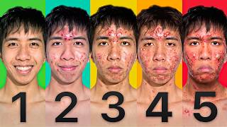 The 5 Stages Of Acne And How To Treat Them