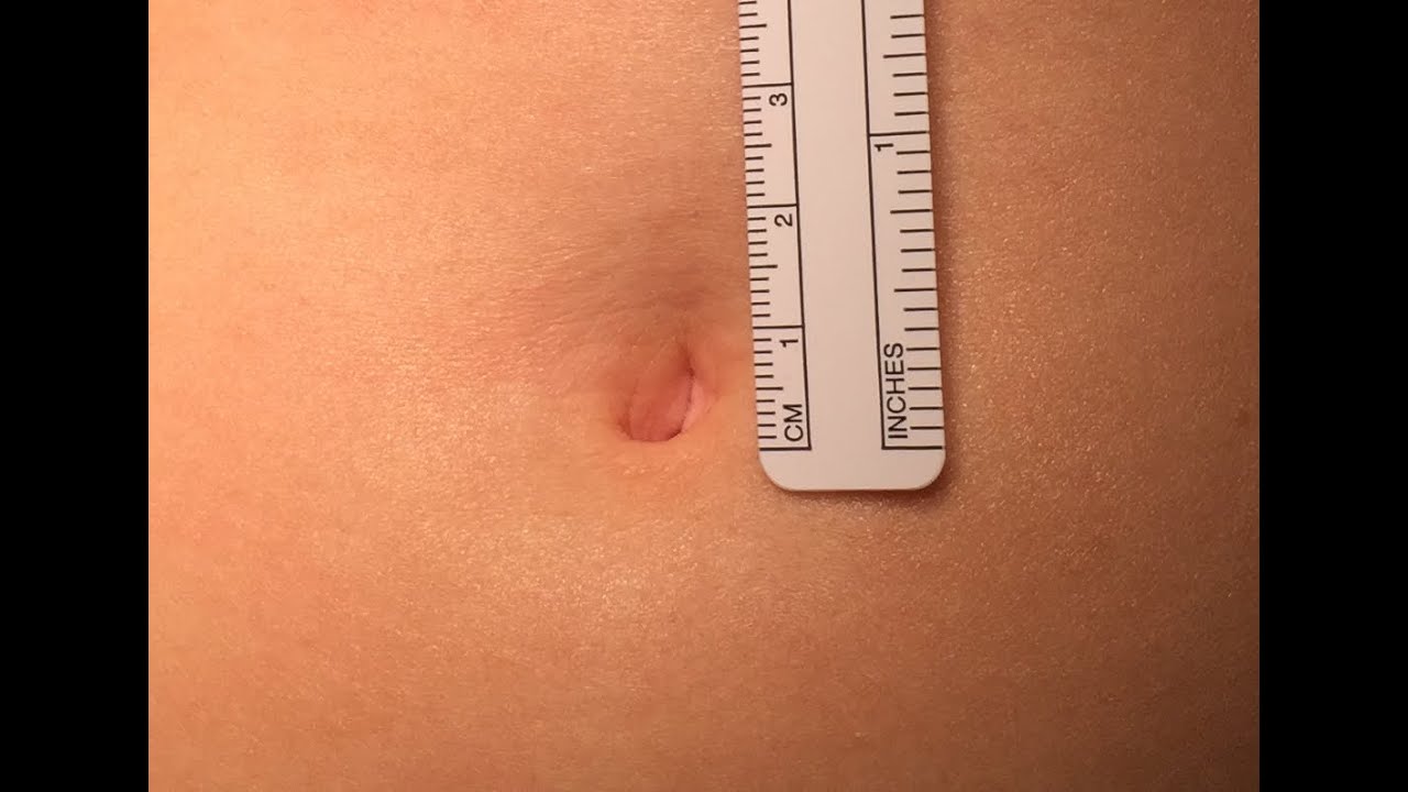 Small Incsion Extra Small Robotic SS Incision - YouTube