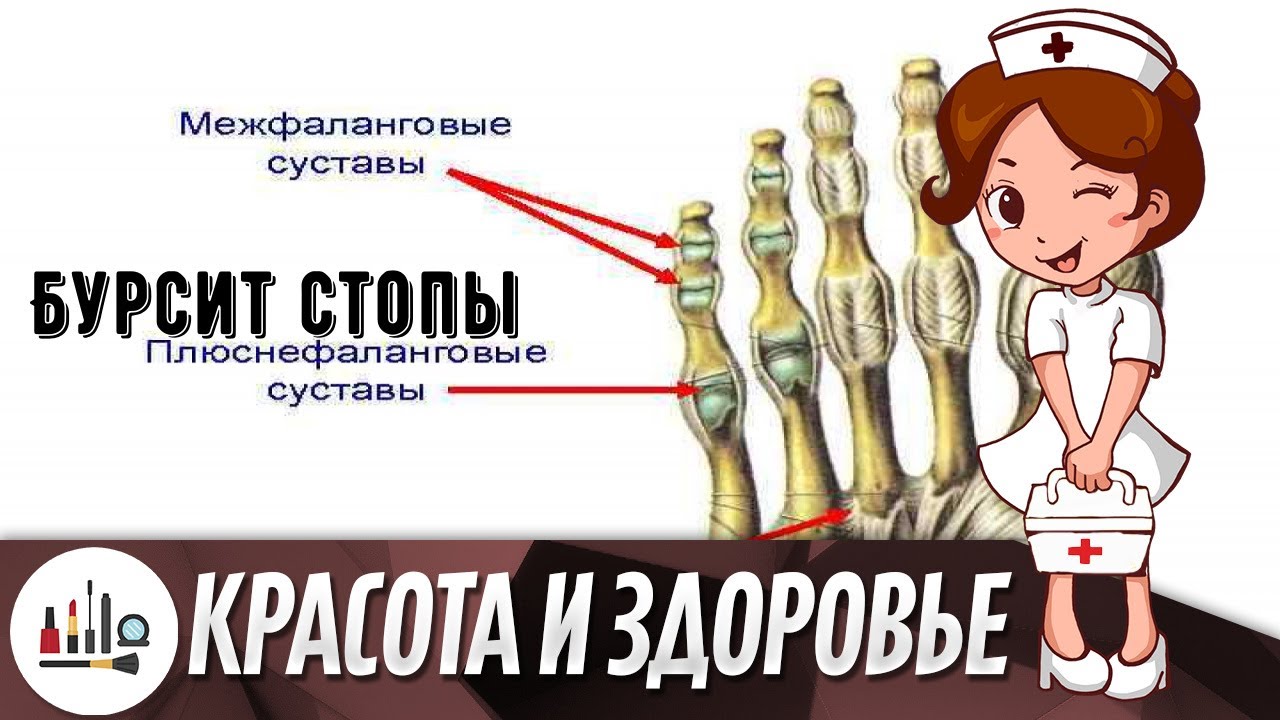 Бурсит стопы