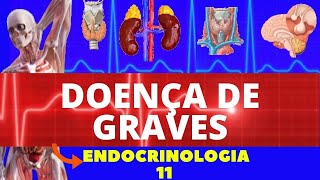 DOENÇA DE GRAVES (CAUSAS, SINTOMAS, DIAGNÓSTICO E TRATAMENTO) - ENDOCRINOLOGIA