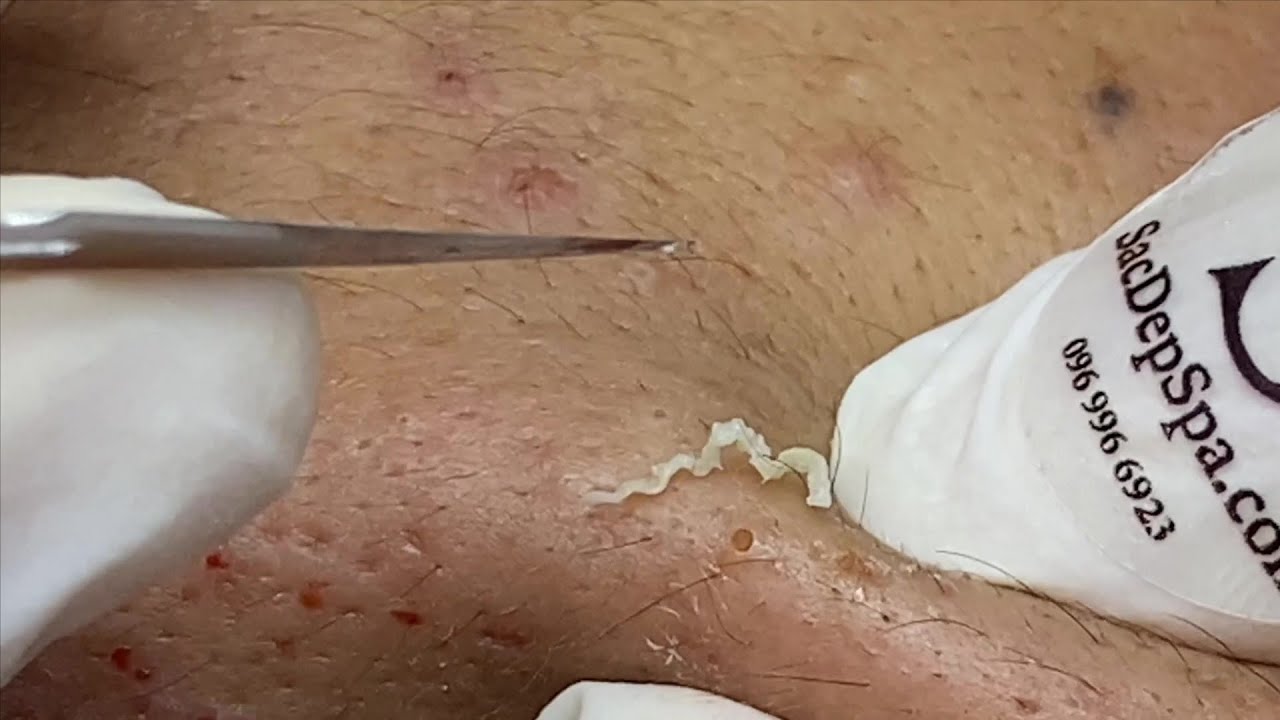 Mụn đầu đen đẹp | Mụn Đầu Đen Đẹp - SacDepSpa#110