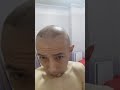 Пересадка волос Астана.2 день1500 -2000 графт