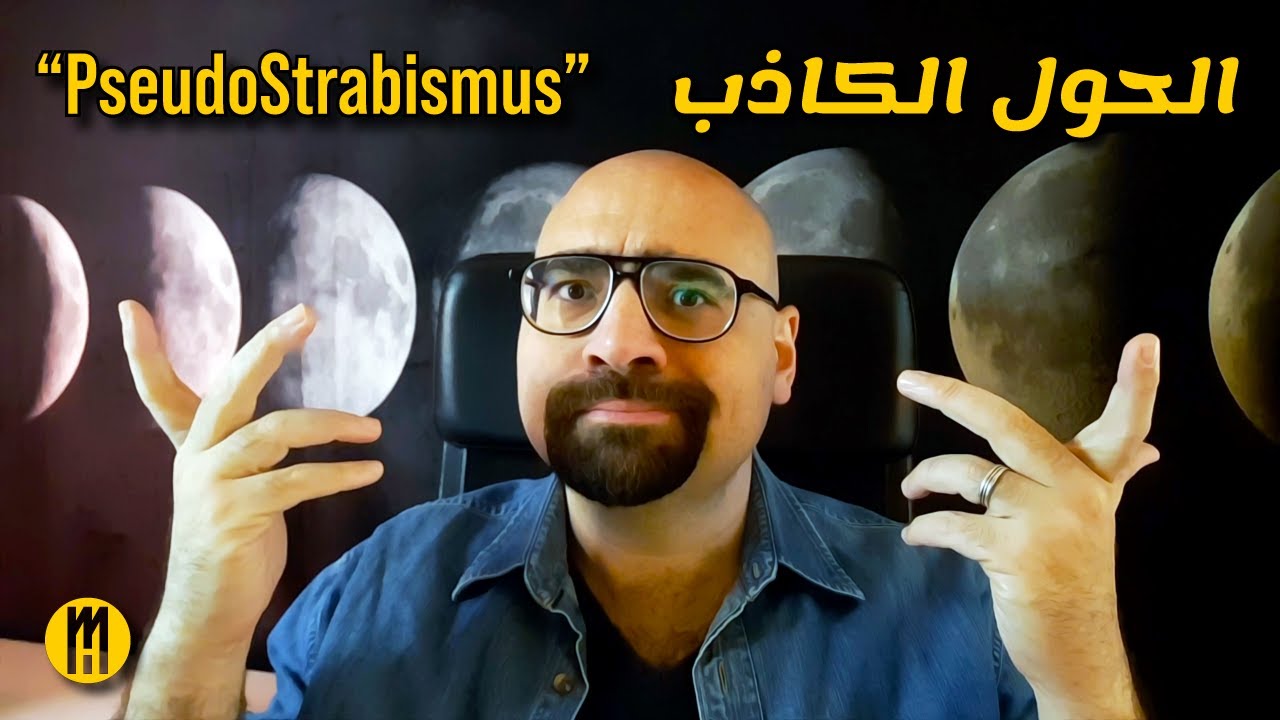 الحول الكاذب أو الغير حقيقي .. PseudoSquint or PseudoStrabismus