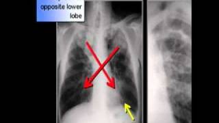 LearningRadiology 50 (30 Imaging Signs) screenshot 2