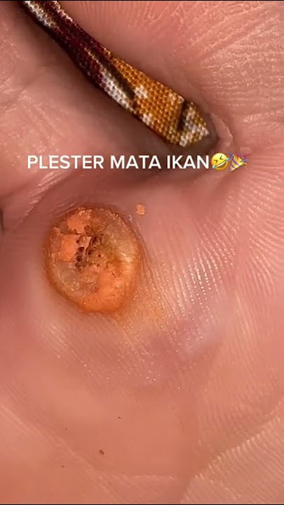 Plester Ji Yan Gao ini sangat baik untuk mengobati dan menghilangkan kutil, mata ikan , sejenisnya