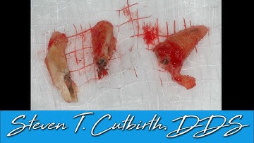 Sectioning Extraction of Molar with PRF Socket Preservation - with Steven T. Cutbirth, DDS