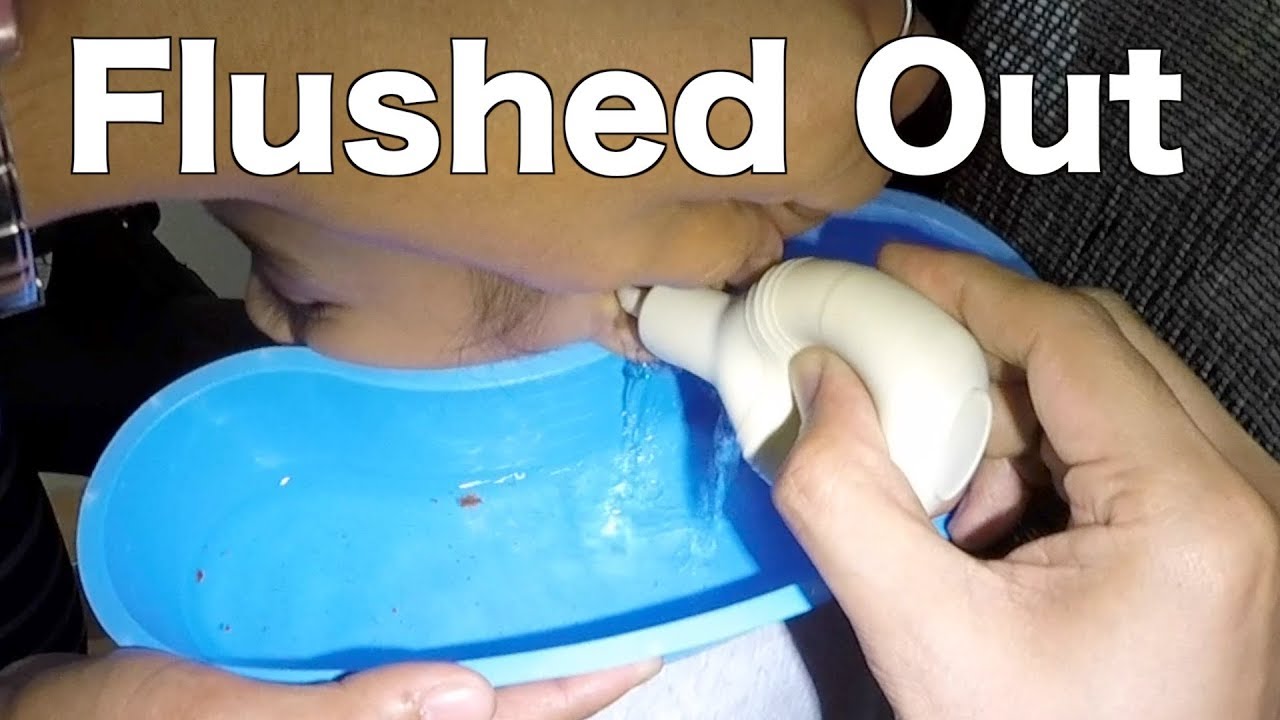 Girl's Hard Earwax Removed by Ear Irrigation Flush that Wax Out