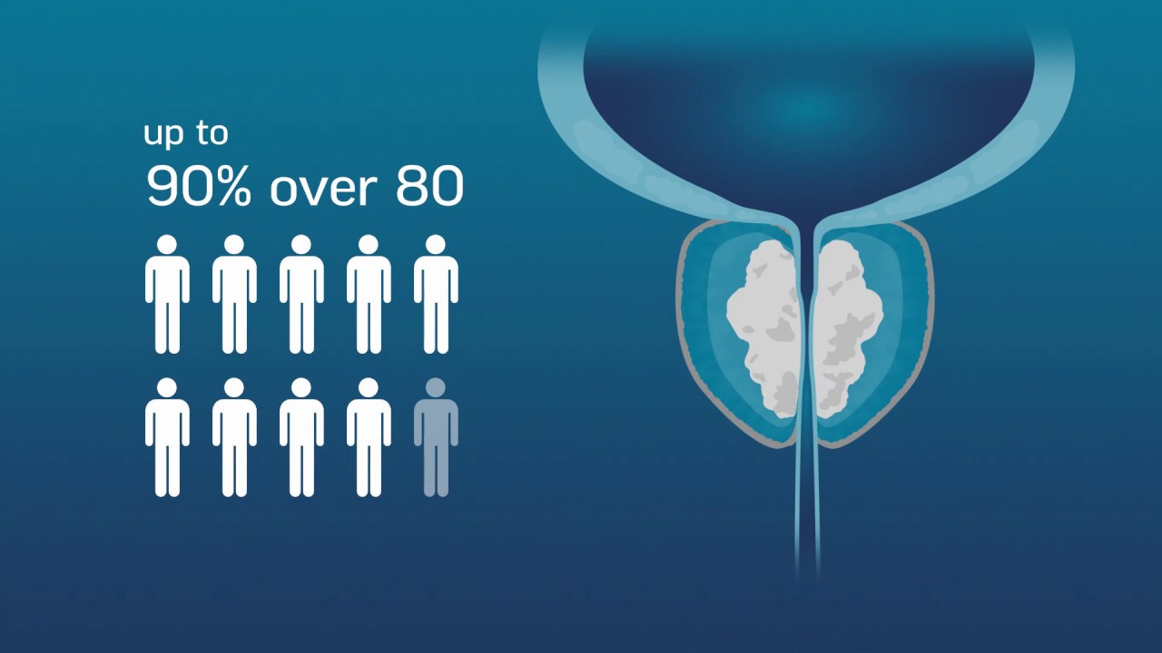 Rezum Information for Atlanta Cosmetic Urology