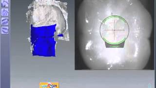 E4D Dentist 4.5 Buccal Bite