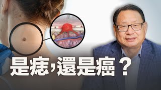 是痣還是黑色素瘤？ 「ABCDE」方法簡單分辨。