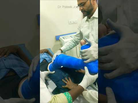 Above Knee Fiberglass Cast For Tibia Fracture Cast Fracture Plaster Fiberglass Ortho