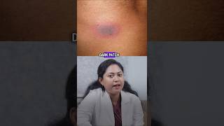 This could be Fixed drug eruption 👉🏽 #dermaone #skincare #visakhapatnam #skinreactions