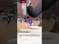 Saatnya upgrade kulitmu dengan laser treatment!Tanpa sakit, tanpa downtime
