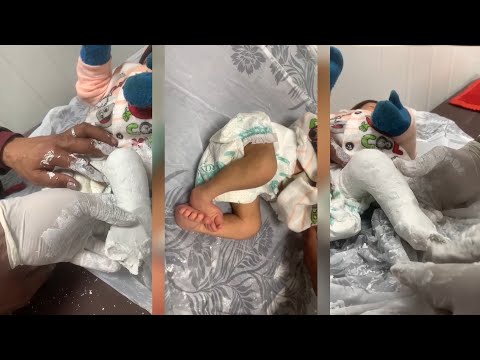 MIRACLE Treatment for Clubfoot: Watch How It Transforms a Child’s Life!