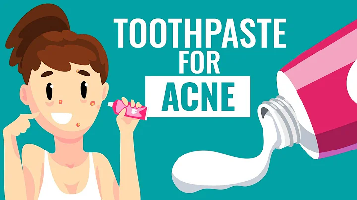 Is Using Toothpaste For Acne safe? || Know the Truth