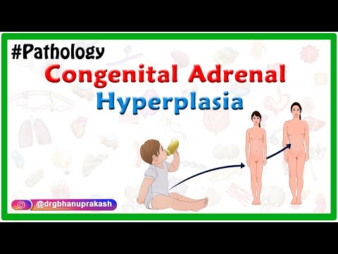 Congenital adrenal hyperplasia : Etiology ,Pathophysiology ,Clinical features ,Diagnosis ,Treatment