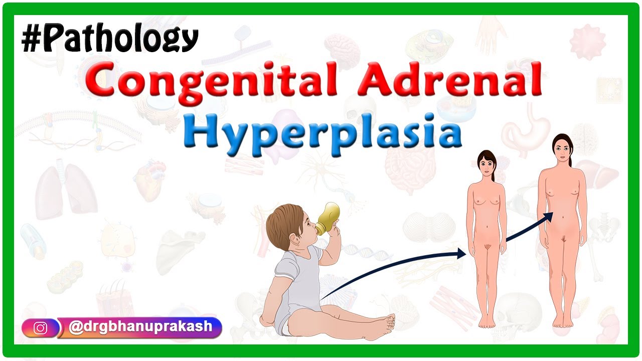 congenital adrenal hyperplasia chart