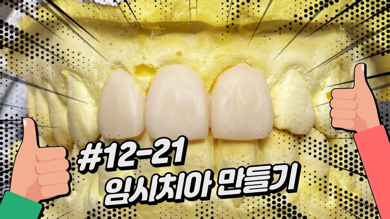 쉽고 재미있는 임시치아 만들기 l 전치부 임시치아 l 임시치아 l temporary crown