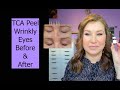 TCA Peel for Eyelids - Before & After, Demo - Wrinkly/Mature Eyes