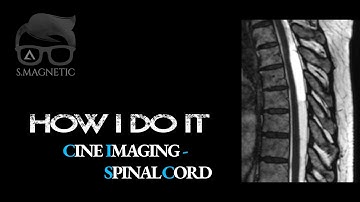 CINE IMAGING – SPINAL CORD (HOW I DO IT)