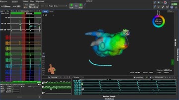 RHYTHMIA HDx™ Mapping System