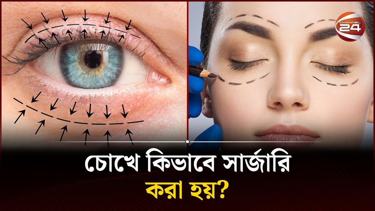 Eye Channeling চোখে কিভাবে সার্জারি করা হয়? | Surgery | Eye | Channel 24 - YouTube