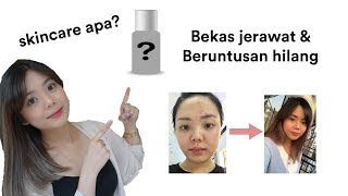 CARA MENGHILANGKAN BEKAS JERAWAT MERAH & BERUNTUSAN