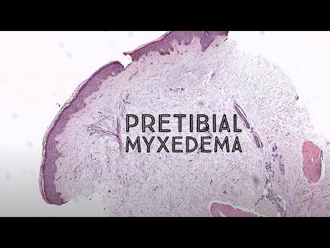 Video: Je pretibiální myxedém bolestivý?