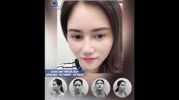 Kết quả khách hàng nâng mũi Sline cấu trúc 4D tại - Thẩm mỹ viện Gangwhoo