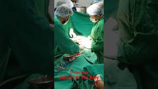 Caesarean Section Delivery OF The Baby ll Daily Med