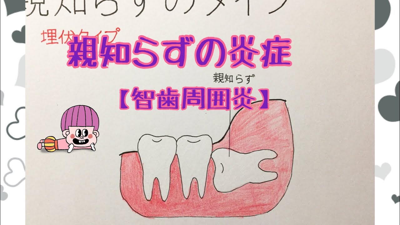 親知らずの炎症 智歯周囲炎 ーはる歯科診療室 Youtube 親知らずの炎症 智歯周囲炎 ーはる歯科診療室 Youtube
