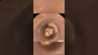 Asmr Satisfying Ear Cleaning & Bug Removal Animation Tickling Tingle Sound