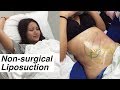 Liposuction Without Surgery + Coolsculpting @ LaserAway