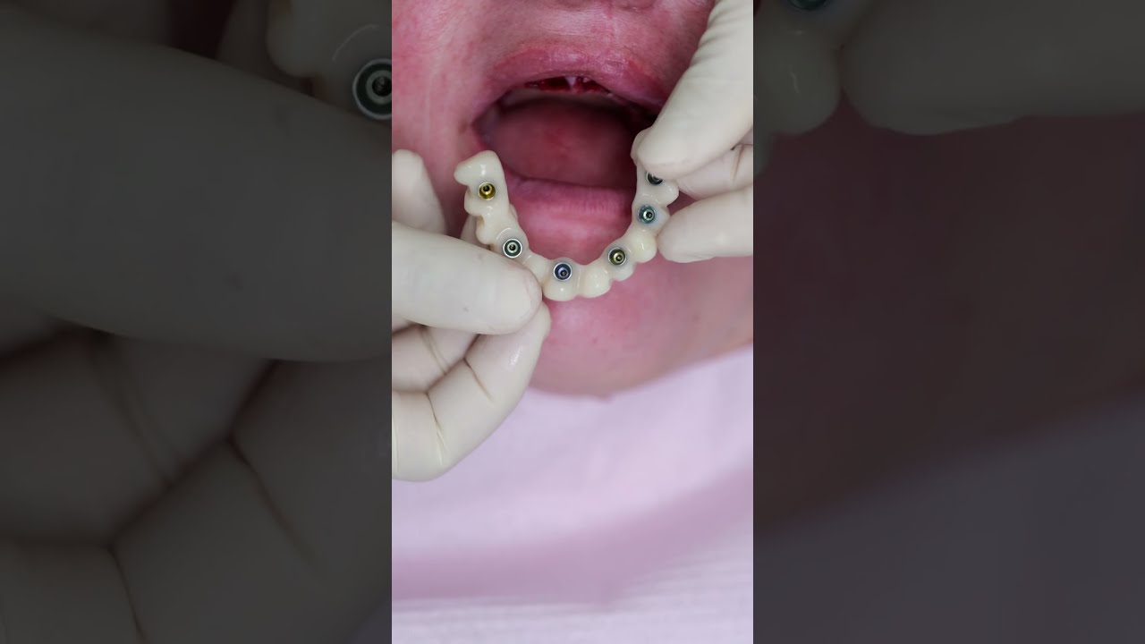 Dental Implant S All On 4 Shorts Smile Impossible Dentist Best New Beautiful Shortvideo