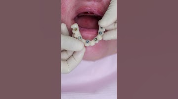 Dental implant’s All on 4 #shorts #smile  #impossible  #dentist #best #new #beautiful #shortvideo