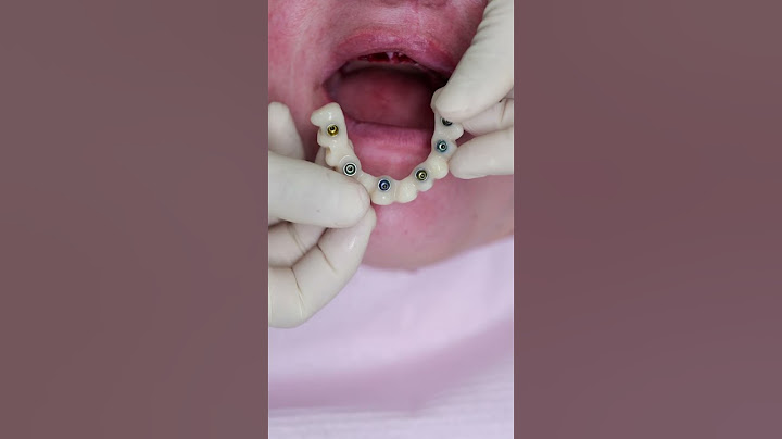 Dental implant’s All on 4 #shorts #smile  #impossible  #dentist #best #new #beautiful #shortvideo